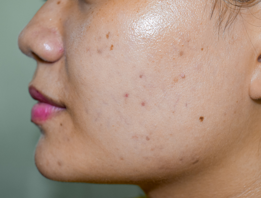 How to Remove Dark Spots Naturally &amp; Get Glowing Skin with Mondka