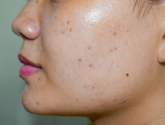 How to Remove Dark Spots Naturally &amp; Get Glowing Skin with Mondka