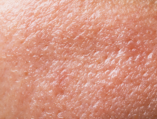 The Best Moisturizer for Oily Skin & Skin Barrier Repair