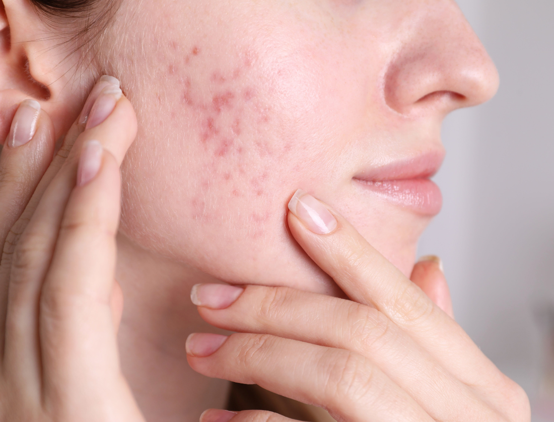 The Best Face Wash for Acne-Prone Skin in Pakistan — and So Much More
