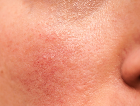 The Best Moisturizer for Sensitive Skin in Pakistan